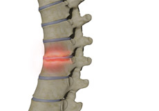 Spondylodiscitis Treatment Murfreesboro TN | Spinal Infection Nashville TN